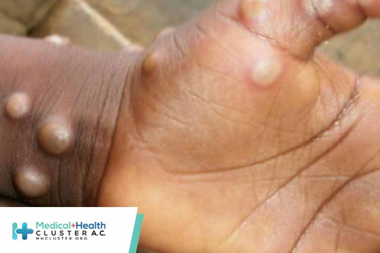 Neonatal Monkeypox Virus Infection